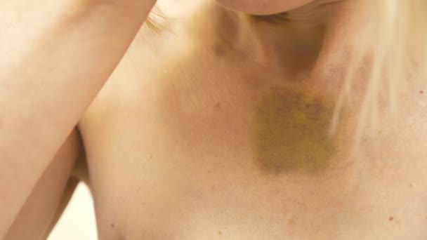 Prellungen am Hals und an der Brust einer Frau. 4k, Nahaufnahme — Stockvideo