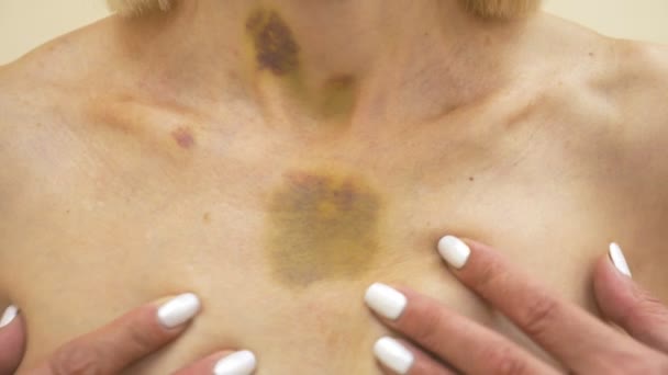 Bruises on the neck and chest of a woman. 4k, close-up — Stock Video