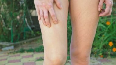 Sivrisinek ısırıkları bacak el ile cilt üzerinde yumuşak kaşıntılı kırmızı diken diken kaşı. 4 k, yakın çekim, ağır çekim çekim, steadicam