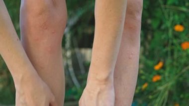 Sivrisinek ısırıkları bacak el ile cilt üzerinde yumuşak kaşıntılı kırmızı diken diken kaşı. 4 k, yakın çekim, ağır çekim çekim, steadicam