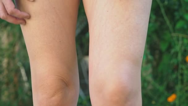 Grattez les bosses rouges démangeaisons molles sur la peau des piqûres de moustiques sur la jambe avec la main. 4k, gros plan, prise de vue au ralenti, steadicam — Video
