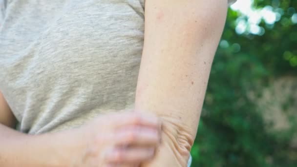 Царапины мягкие зудящие красные шишки на коже от укусов комаров на руке. 4k, крупный план, замедленная съемка, стабикам — стоковое видео