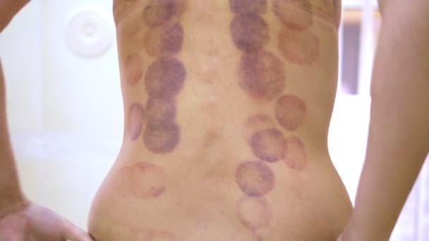 丸い打撲傷真空カッピングマッサージの手順の後、若い女性の背中に痕跡。ラウンド打撲傷 — ストック動画