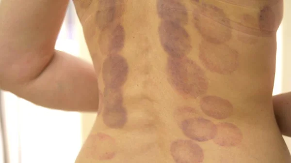 Okrągłe siniaki. Ślady na tylnej części młodej kobiety po procedurze masażu próżniowego bańki. Okrągłe siniaki — Zdjęcie stockowe