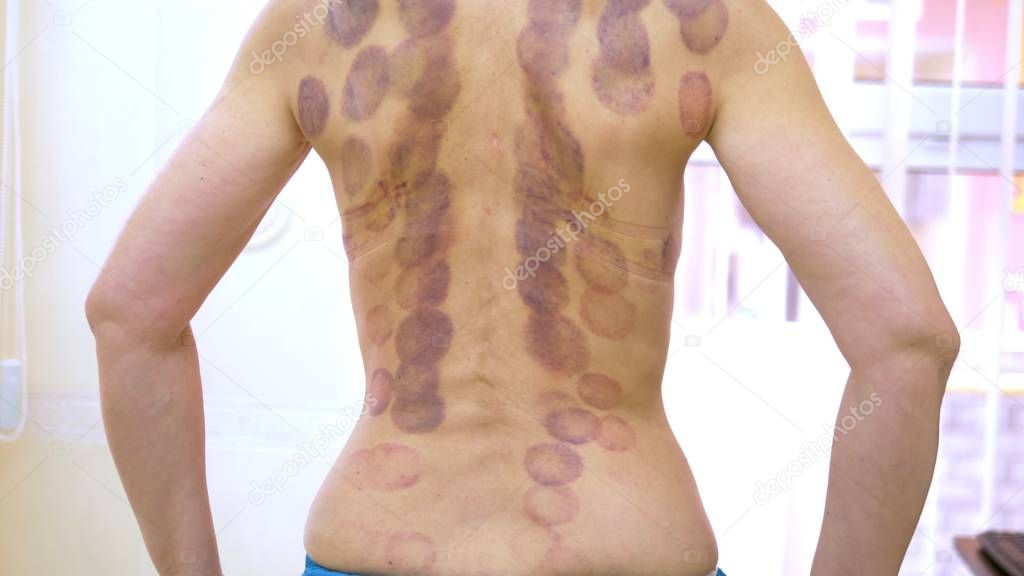 Moretones Rastros en la espalda de una mujer joven