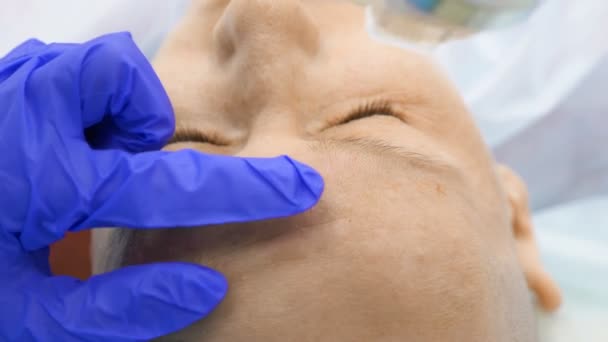 Närbild. Microneedle RF-lyft förfarande. Hårdvara kosmetika. Kosmetolog genomför en ansikts föryngring förfarande för en skallig kvinna. — Stockvideo
