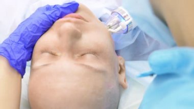 Close. microneedle Rf kaldırma işlemi. Donanım kozmetolojisi. Güzellik uzmanı kel bir kadın için yüz gençleştirme prosedürü uygular..