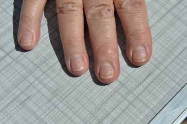 Deri hastalıkları tahriş, kaşıntı, çatlak yaralar acı verici hislere yol açar. Deride papillomlar, siğiller, benler, beyaz ve koyu benekler oluşabilir..