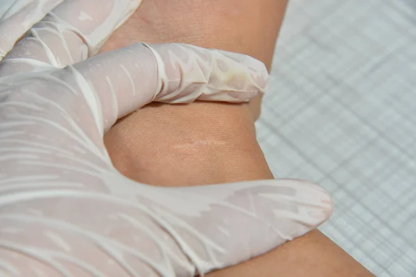 Δερματικές Παθήσεις Ερεθισμός Φαγούρα Ραγισμένες Πληγές Οδηγούν Οδυνηρές Αισθήσεις Δέρμα — Φωτογραφία Αρχείου