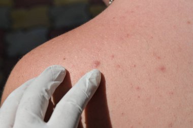 Deri hastalıkları tahriş, kaşıntı, çatlak yaralar acı verici hislere yol açar. Deride papillomlar, siğiller, benler, beyaz ve koyu benekler oluşabilir..