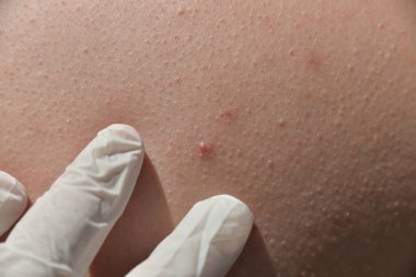 Deri hastalıkları tahriş, kaşıntı, çatlak yaralar acı verici hislere yol açar. Deride papillomlar, siğiller, benler, beyaz ve koyu benekler oluşabilir..