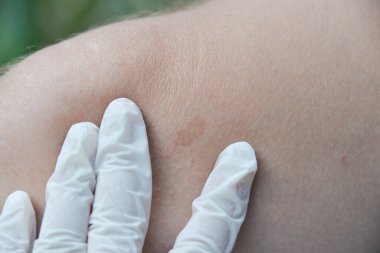 Deri hastalıkları tahriş, kaşıntı, çatlak yaralar acı verici hislere yol açar. Deride papillomlar, siğiller, benler, beyaz ve koyu benekler oluşabilir..