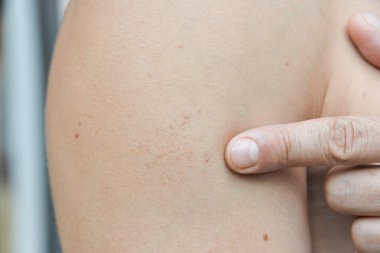 Deri hastalıkları tahriş, kaşıntı, çatlak yaralar acı verici hislere yol açar. Deride papillomlar, siğiller, benler, beyaz ve koyu benekler oluşabilir..