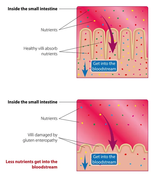 吸收营养素在小肠 健康和受损的绒毛 医学向量例证 — 图库矢量图片
