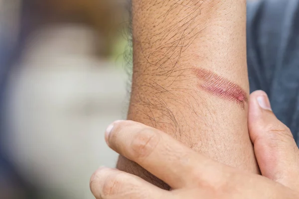 Close Burning Skin Arm Injury Fire — Stock Photo, Image