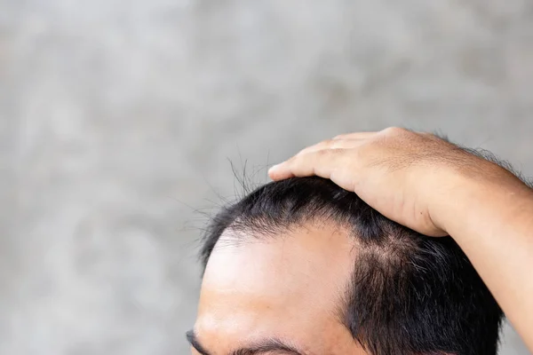 Feche Homem Tocando Sua Cabeça Para Mostrar Careca Problema Glabrous — Fotografia de Stock