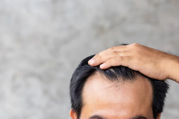 Close Man Touching His Head Show Bald Head Glabrous Problem — Stock Photo, Image