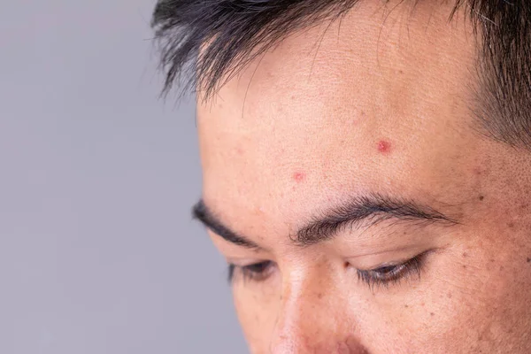Macro face skin of asian man to show many skin problem. Men skin care concept on grey space background