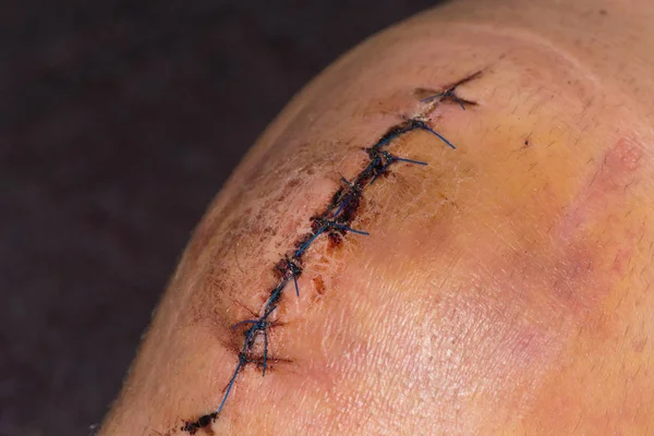 Männliches Knie Nach Chirurgischer Operation Knieersatz Knie Operation Krankenhaus — Stockfoto