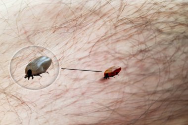 Kene deride sürünür. İnsan vücudunun üzerinde yürüyorum. Kene beyin iltihabı, Lyme hastalığı, babesiosis ve ehrlichiosis salgılar..