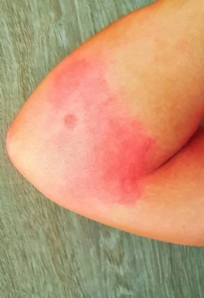 Red Rash Patient Who Bitten Insect — Stock Photo, Image