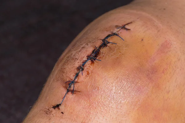 Männliches Knie Nach Chirurgischer Operation Knieersatz Knie Operation Krankenhaus — Stockfoto