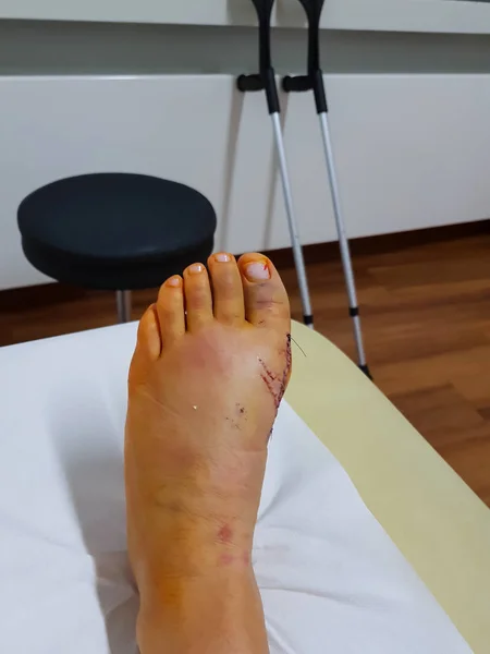 Scar at the foot of the operation