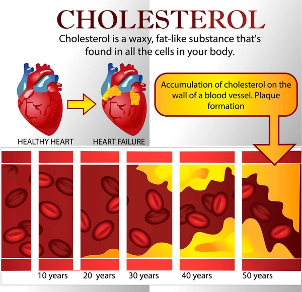 Heart Attack Atherosclerosis Medical Illustration Healthy Damaged Heart Blood Vessel — Stock Vector