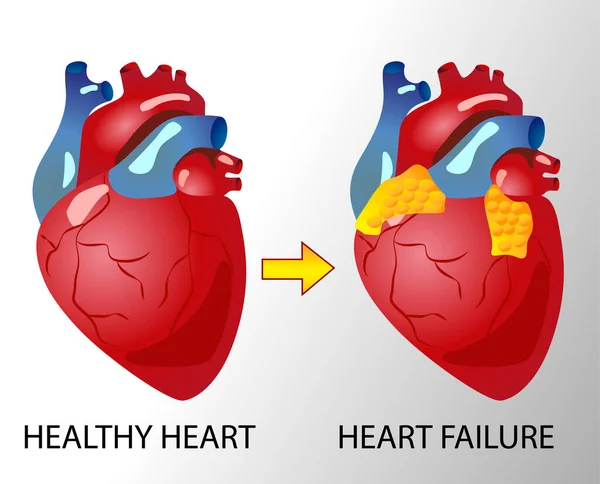 示意图显示人类心脏图解 心脏病和动脉粥样硬化医学资讯图 健康和受损的心脏 — 图库矢量图片