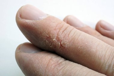 Parmakları kırık Cilt Kuru. Silah Dermatoloji sorunları ile.