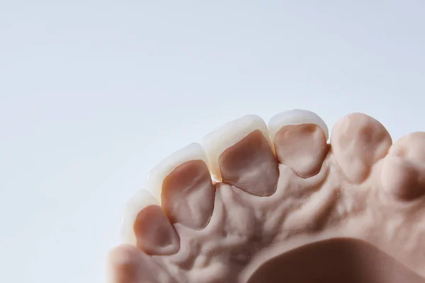 Folheados dentários cerâmicos. Visão de close-up do layout dental da linha inferior da prótese de dentes na mandíbula artificial, conceito médico. Dof rasa. — Fotografia de Stock