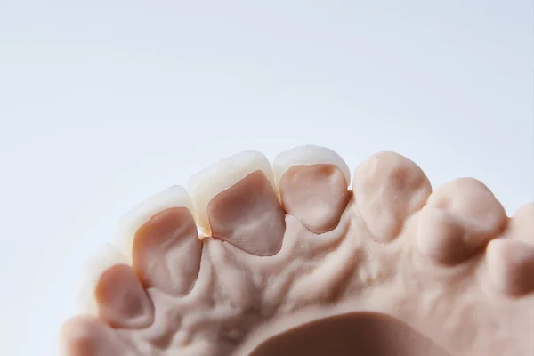 Folheados dentários cerâmicos. Visão de close-up do layout dental da linha inferior da prótese de dentes na mandíbula artificial, conceito médico. Dof rasa. — Fotografia de Stock