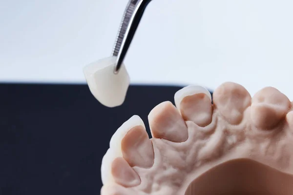 Ceramic dental veneers. Close-up view of dental layout of lower row of teeth prothesis on artificial jaw, medical concept. Shallow dof. — Stock Photo, Image