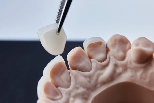 Chapas dentales de cerámica. Vista de cerca de la disposición dental de la fila inferior de la prótesis de dientes en la mandíbula artificial, concepto médico. Dof poco profundo. — Foto de Stock