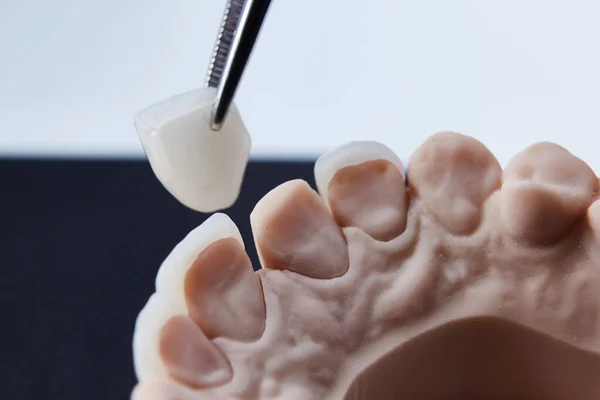 Ceramic dental veneers. Close-up view of dental layout of lower row of teeth prothesis on artificial jaw, medical concept. Shallow dof. — Stock Photo, Image