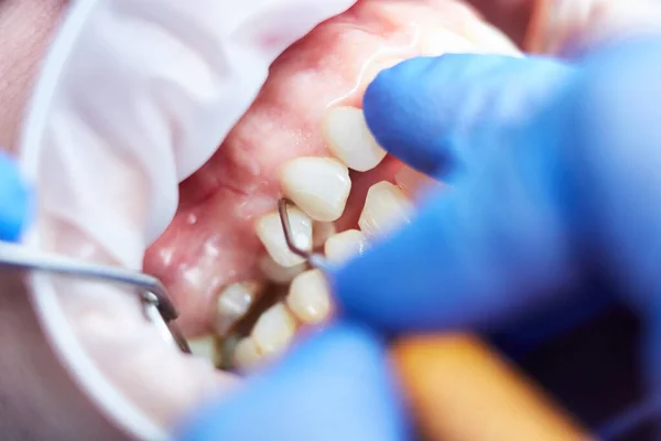 Makro zbliżenie ludzkich zębów siekierą i lustrem do ust. Płytkie dof. — Zdjęcie stockowe