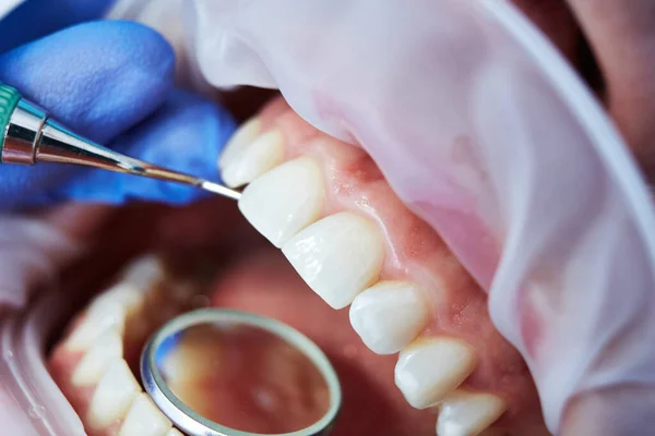 Macro close-up de dentes humanos com machado e espelho bucal. Dof rasa. — Fotografia de Stock