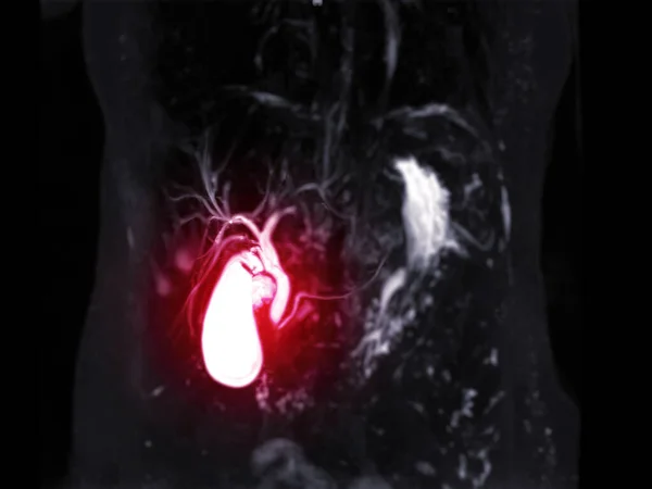 Magnetische Resonantie Cholangiopancreatografie Mrcp Mip Beeld Tonen Visualiseren Galwegen Pancreas — Stockfoto