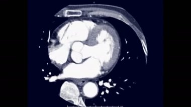 Axial view 'da kalbin CTA koroner arteri veya CT anjiyografisi Enjeksiyon kontrast ortam aracı ile yavaş çekimde.