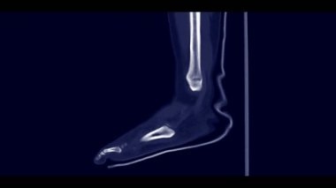 Bacak kırığı teşhisi için CT-Foot sagittal görünümü.