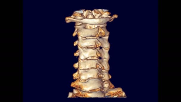 C脊椎または子宮頸椎3Dレンダリング患者の外傷症例の画像は モニター上で好転します 医療技術の概念 — ストック動画