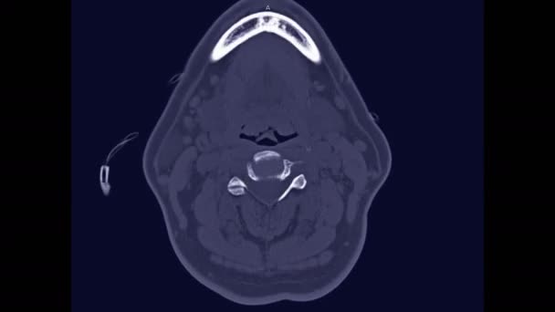 Tomografía Computarizada Columna Vertebral Cervical Vista Axial Del Caso Trauma — Vídeo de stock