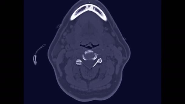 Coluna Vertebral Coluna Cervical Visão Axial Caso Trauma Paciente Para — Vídeo de Stock