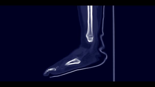 Vue Sagittale Pied Pour Diagnostic Fracture Pied — Video