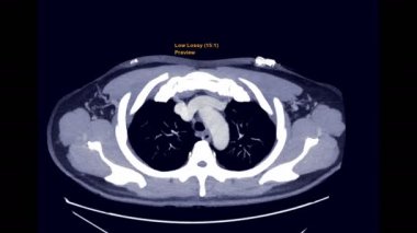 PE ya da pulmoner embolizma için CTA, kontrast ortam aracı eksen MIP Görünümü ile CT Göğüs pulmoner embolizmayı tespit etmek için.