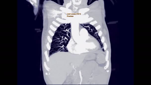 Cta Para Embolia Pulmonar Pecho Con Medio Contraste Coronal Mip — Vídeos de Stock