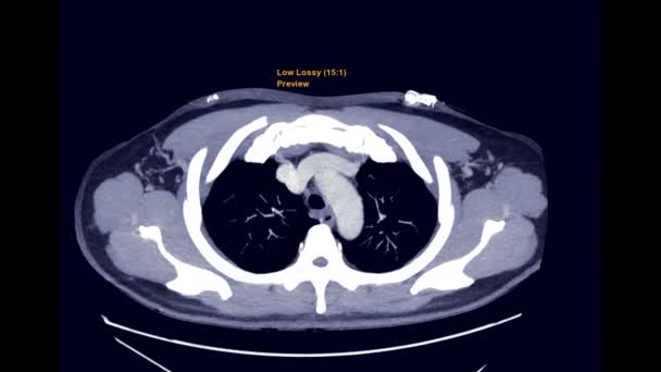 Cta Para Embolia Pulmonar Pecho Con Medio Contraste Mip Axial — Vídeo de stock