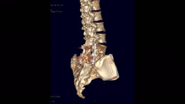 CT Lumbar omurga veya L-S omurga 3D görüntüleme Pedikül vida fiksasyonu ile ekranda dönün. 3B illüstrasyon.