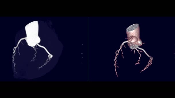 Comparar Cta Coronary Artery Rendering Image Mip Showing Coronary Artery — Vídeo de stock