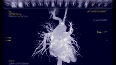 Pulmoner arter MIP teknikli CTA torasik aort 3D görüntüleme ekranda dön.